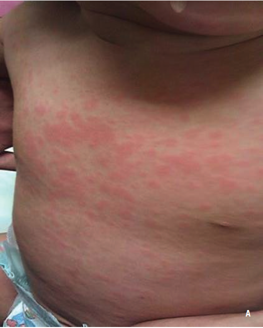 Systemic Onset Juvenile Idiopathic Arthritis Consultant360